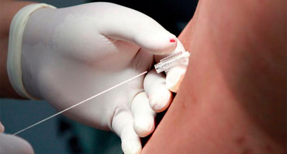 La partoanalgesia La partoanalgesia
