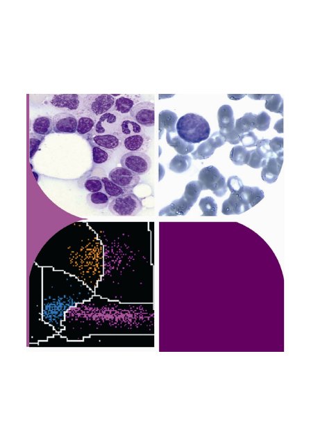LINFOMI A CELLULE T: inquadramento, fisiopatologia ed approccio diagnostico nel laboratorio di primo livello