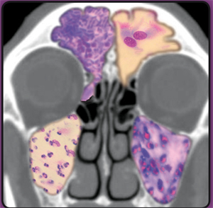 Attualità sulle rinosinusopatie