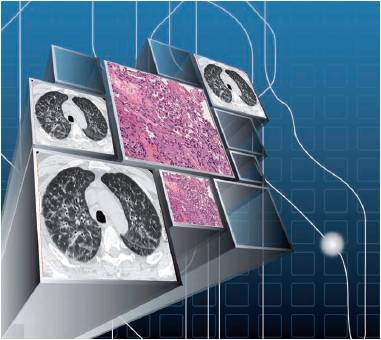 Interstiziopatie e HRCT