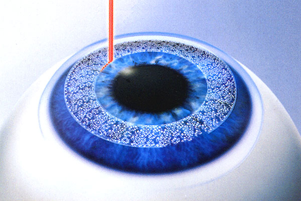 Il femtolaser oggi. Cornea e cataratta