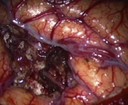  Tumori del cervello, interventi chirurgici più precisi con la tecnica che colora di rosa le zone colpite