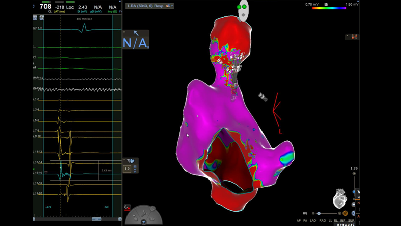 Prima cardioneuroablazione alla Cardiologia dell’ospedale Maggiore in una paziente con frequenti svenimenti